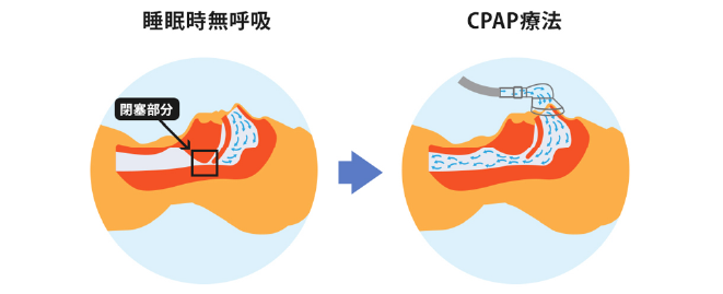 CPAP療法原理